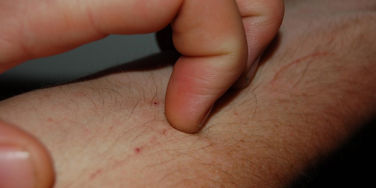 Gatal dan Ruam di Belakang Lutut